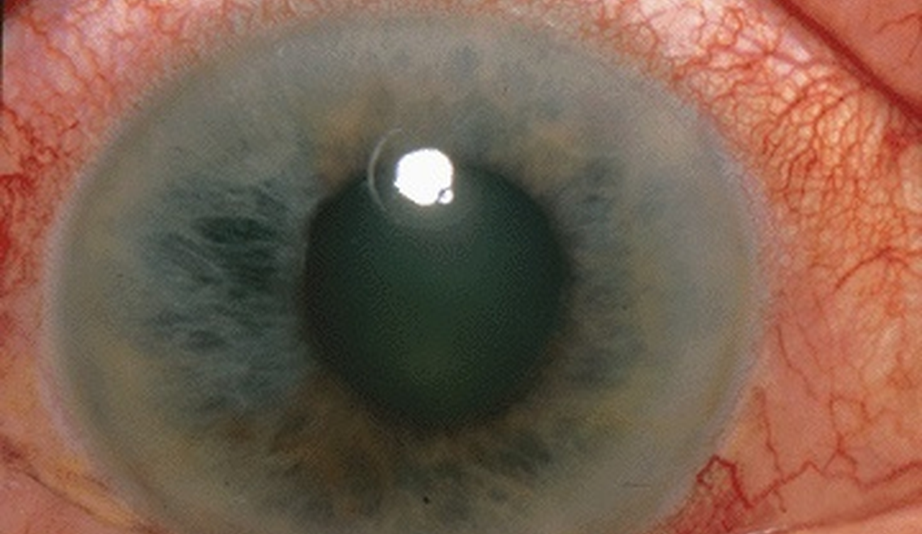 Zdjęcie ukazujące ostrą jaskrę pierwotną zamykającego się kąta.  Autorstwa Jonathan Trobe, M.D. - The Eyes Have It, CC BY 3.0