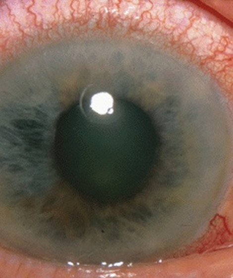 Zdjęcie ukazujące ostrą jaskrę pierwotną zamykającego się kąta. Autorstwa Jonathan Trobe, M.D. - The Eyes Have It, CC BY 3.0